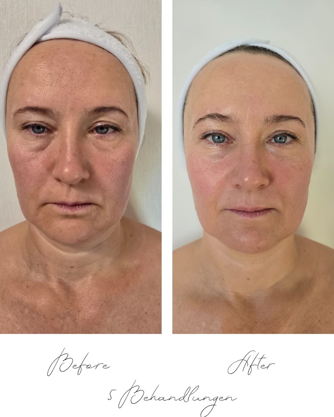 Behnadlung 5